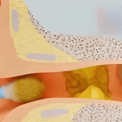 EarFlow™ Éliminateur de Cérumen | Élimine 95 % du cérumen en 60 secondes